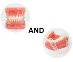 ワイヤー矯正とマウスピース矯正の写真